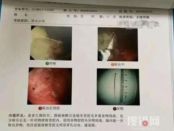 寶媽稱(chēng)醫(yī)院誤將針掉進(jìn)孩子胃中 為什么掉進(jìn)胃中？