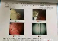 寶媽稱醫(yī)院誤將針掉進(jìn)孩子胃中 為什么掉進(jìn)胃中？