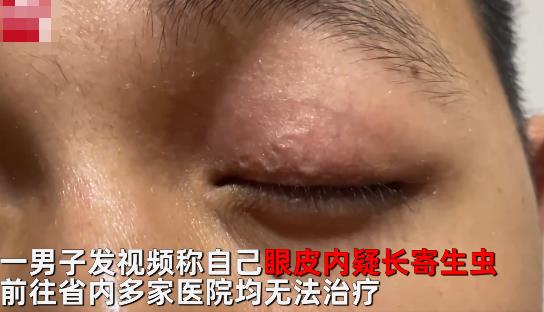 男子左眼皮異常抖動有蟲游走 照片揭露實在是太嚇人了
