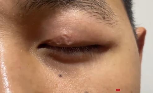 男子左眼皮異常抖動有蟲游走 照片揭露實在是太嚇人了