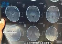 月嫂拍嗝時(shí)打盹致嬰兒頭頂骨骨折 真相曝光簡(jiǎn)直太驚人了