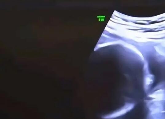 結婚6年沒孩子 查出丈夫非男性 究竟是怎么回事？