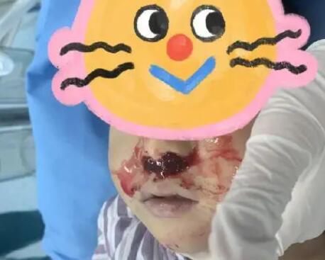 奶奶向3歲男童鼻腔塞頭發(fā)止血 背后原因簡直驚呆了眾人