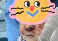 奶奶向3歲男童鼻腔塞頭發(fā)止血 背后原因簡(jiǎn)直驚呆了眾人