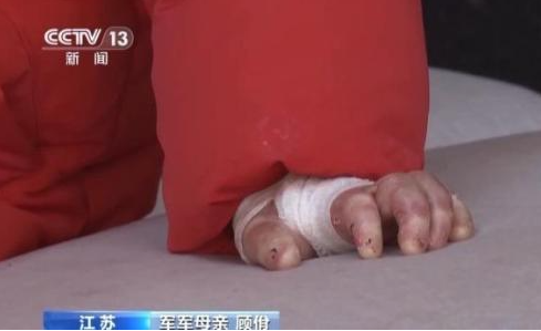 女孩確診“蝴蝶寶貝”皮膚一碰就碎 真相簡直太意外了