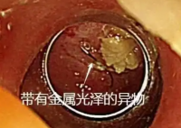 老人突發(fā)高燒拍胸片意外發(fā)現(xiàn)魚(yú)鉤 究竟是怎么回事？