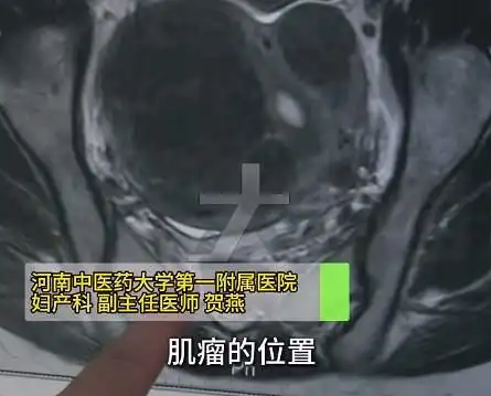 女子愛生悶氣子宮里長了8個瘤 背后真相實在讓人驚愕